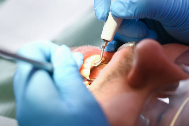 Best Emergency Root Canal Treatment in Windsor, VA